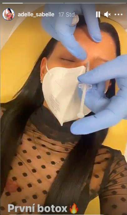 Adelle Sabelle botox-face.png
