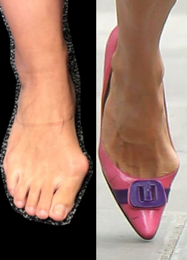 bunions (5).png
