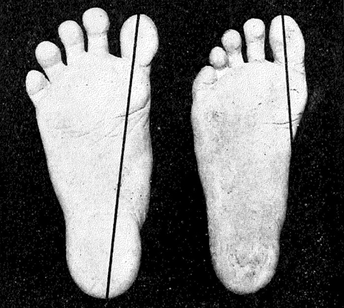 bunion (25)2.jpg