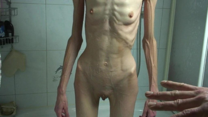anorexia.jpg