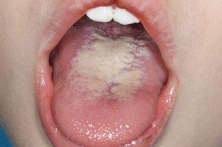 C0017334-Oral_thrush-SPL_1.width-320.jpg